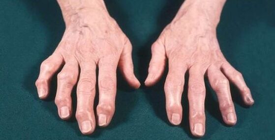 Finger osteoarthritis