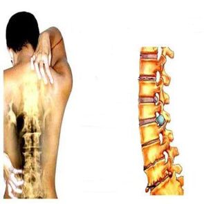 Osteochondrosis stages