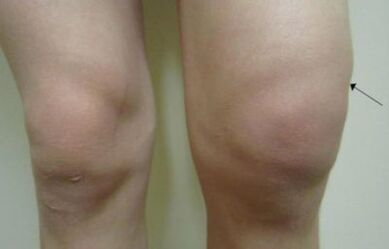 Clinical manifestations of the osteoarthritis of the knee joint