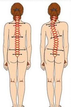 Scoliosis