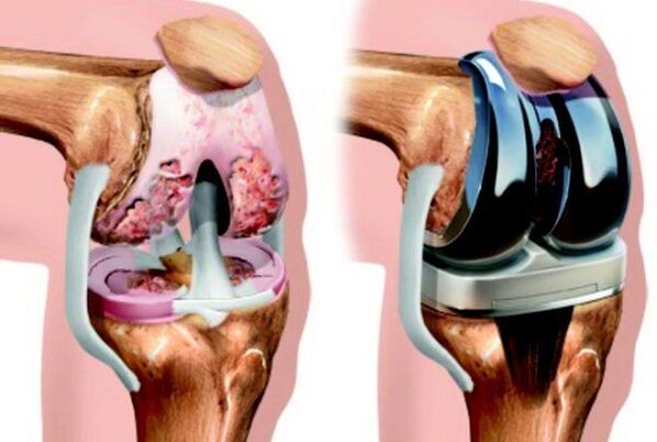 Before and after endoprotetics of the knee joint with osteoarthritis