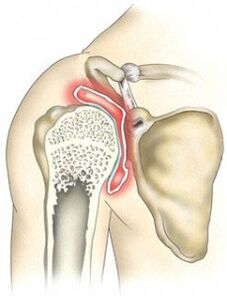Destruction of the shoulder joint due to osteoarthritis.