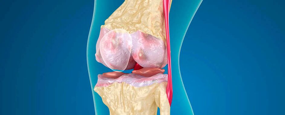osteoarthritis of the knee joint