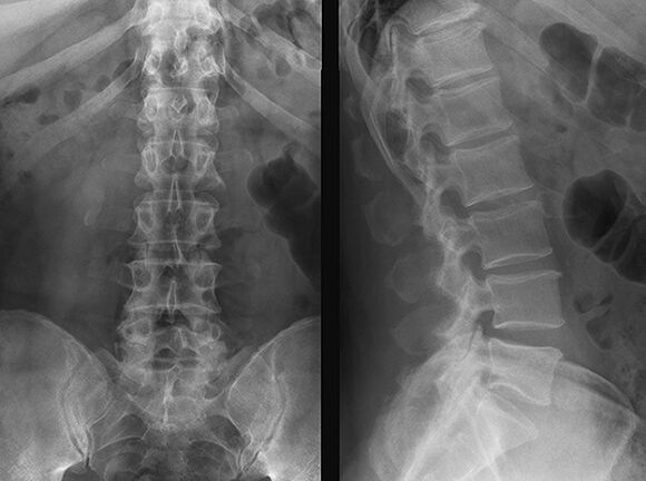 X-ray for the diagnosis of osteochondrosis. 