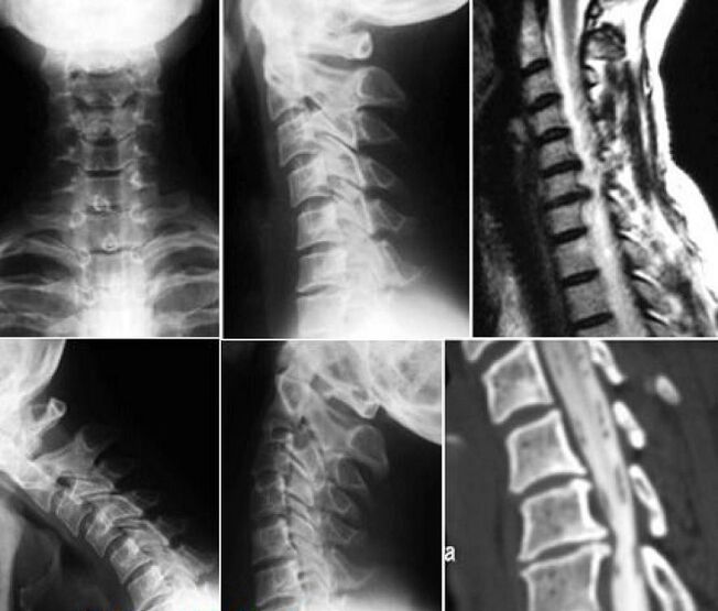 X-ray of the cervical spine for the diagnosis of osteochondrosis. 