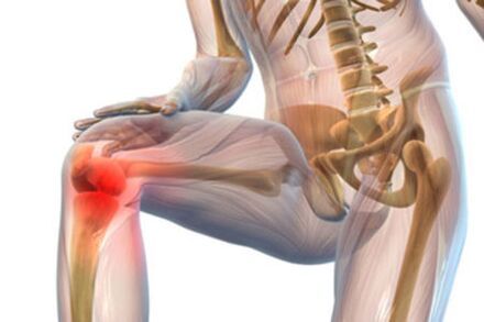 Pain in the knee joint with osteoarthritis. 